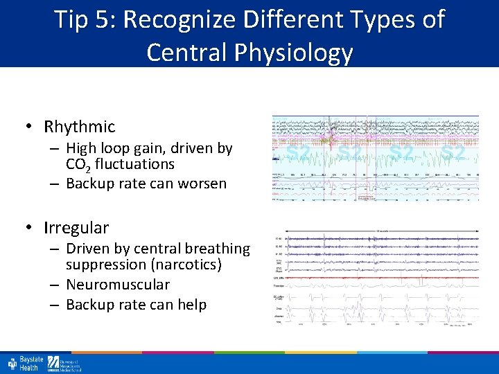 Tip 5: Recognize Different Types of Central Physiology • Rhythmic – High loop gain,