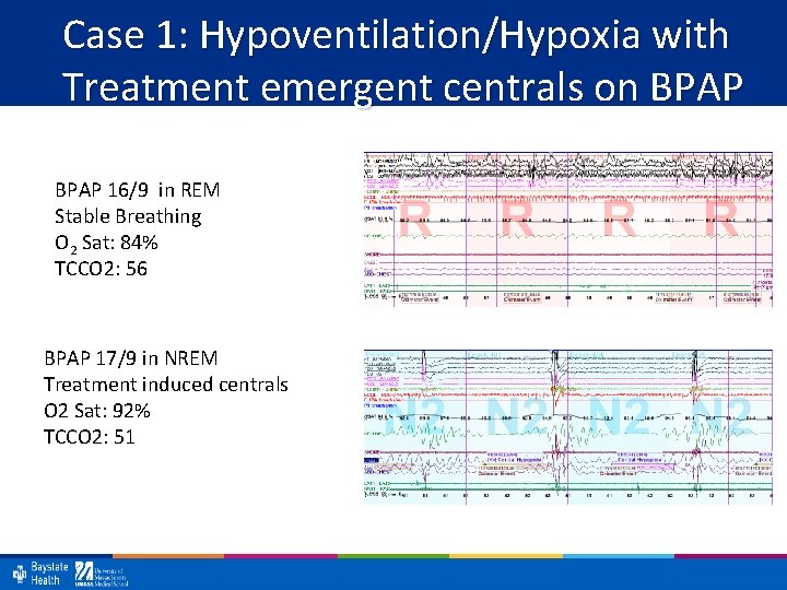 Case 1: Hypoventilation/Hypoxia with Treatment emergent centrals on BPAP 16/9 in REM Stable Breathing