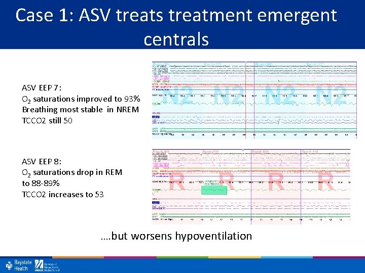 Case 1: ASV treats treatment emergent centrals ASV EEP 7: O 2 saturations improved