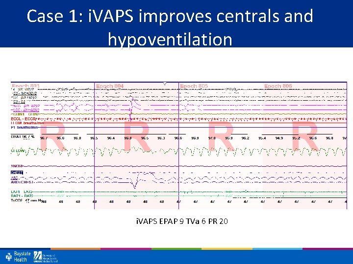Case 1: i. VAPS improves centrals and hypoventilation i. VAPS EPAP 9 TVa 6