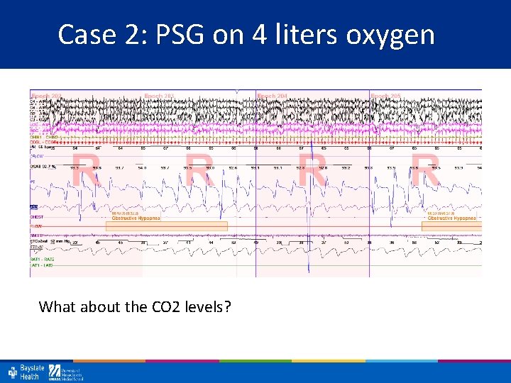 Case 2: PSG on 4 liters oxygen What about the CO 2 levels? 