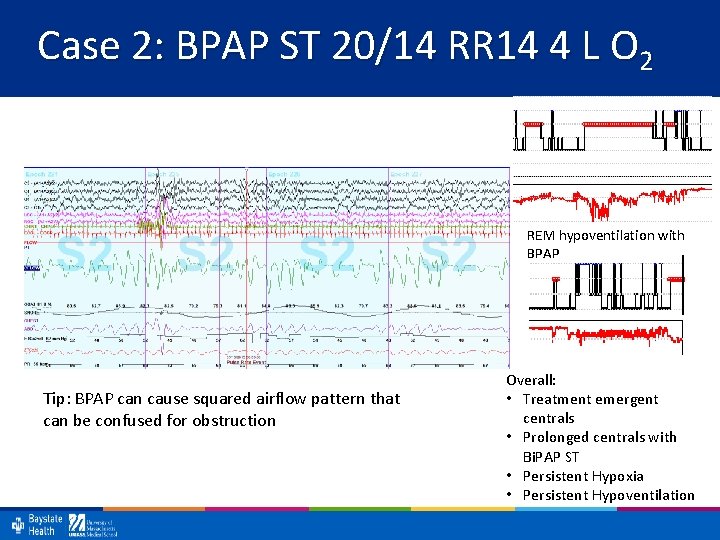 Case 2: BPAP ST 20/14 RR 14 4 L O 2 REM hypoventilation with