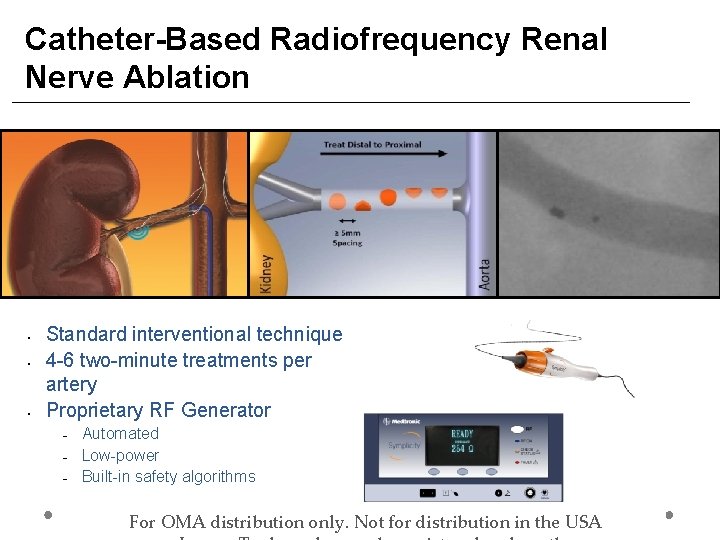 Catheter-Based Radiofrequency Renal Nerve Ablation • • • Standard interventional technique 4 -6 two-minute