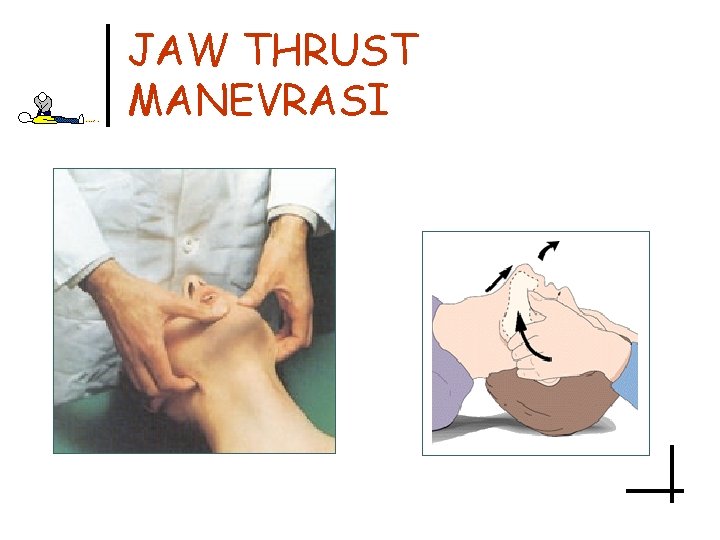 JAW THRUST MANEVRASI 