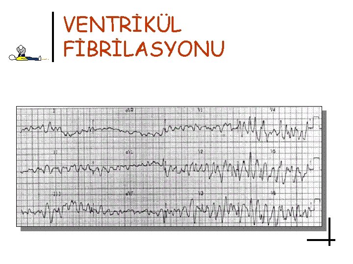 VENTRİKÜL FİBRİLASYONU 