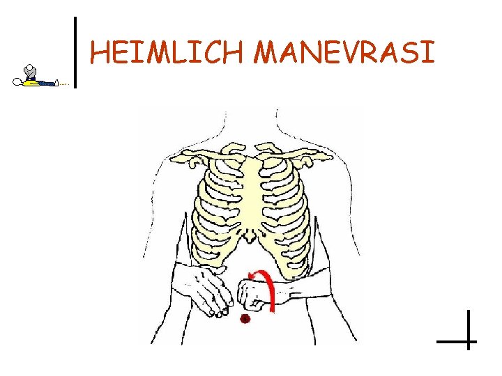 HEIMLICH MANEVRASI 