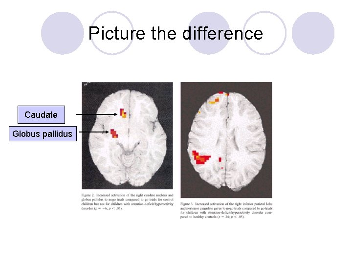 Picture the difference Caudate Globus pallidus 