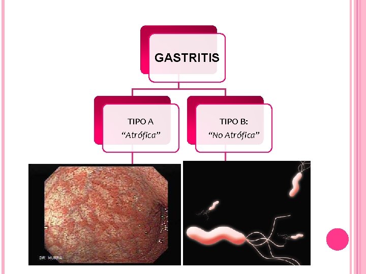 GASTRITIS TIPO A “Atrófica” TIPO B: “No Atrófica” Desaparecen glándulas gástricas H. Pylori 