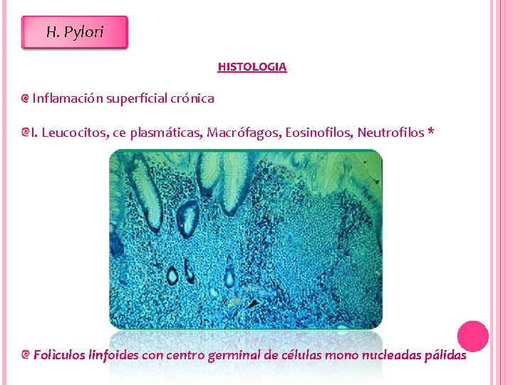 H. Pylori HISTOLOGIA Inflamación superficial crónica I. Leucocitos, ce plasmáticas, Macrófagos, Eosinofilos, Neutrofilos *