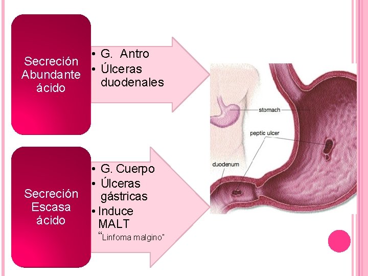  • G. Antro Secreción Abundante • Úlceras duodenales ácido Secreción Escasa ácido •