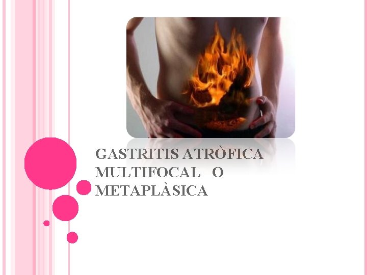GASTRITIS ATRÒFICA MULTIFOCAL O METAPLÀSICA 