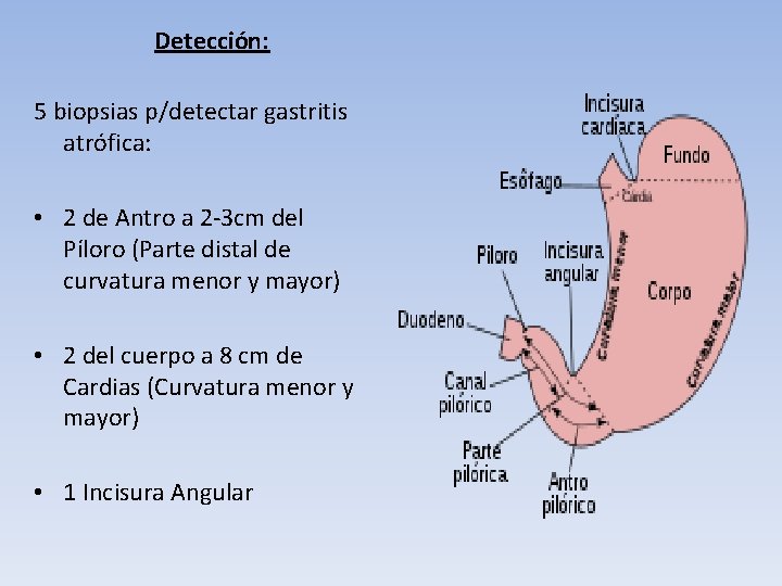 Detección: 5 biopsias p/detectar gastritis atrófica: • 2 de Antro a 2 -3 cm