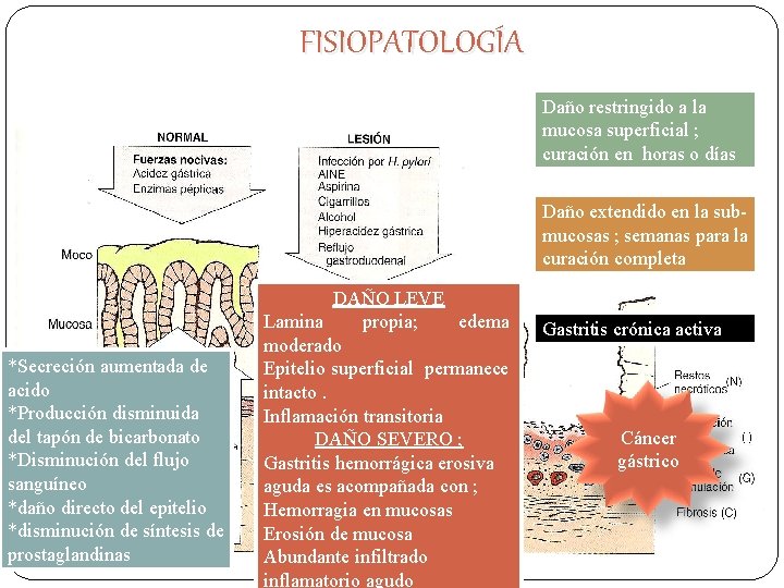 FISIOPATOLOGÍA Daño restringido a la mucosa superficial ; curación en horas o días Daño