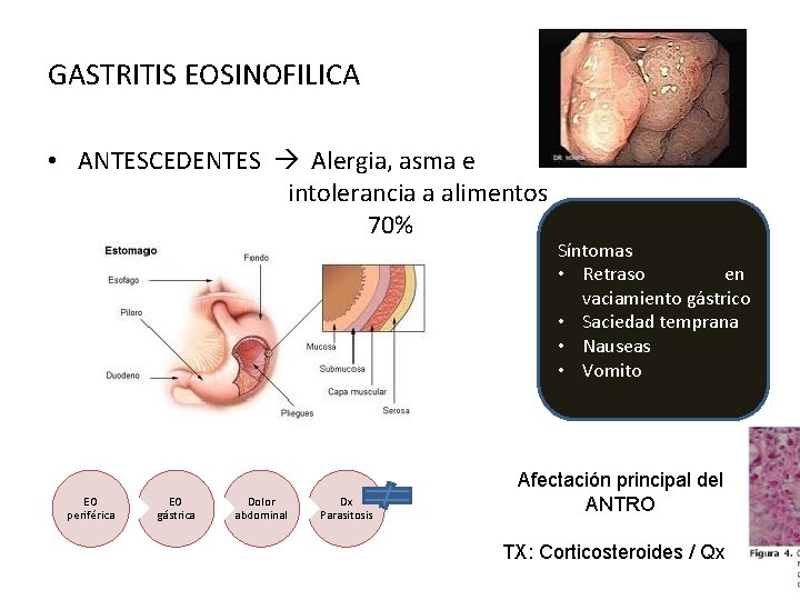 GASTRITIS EOSINOFILICA • ANTESCEDENTES Alergia, asma e intolerancia a alimentos 70% EO periférica EO