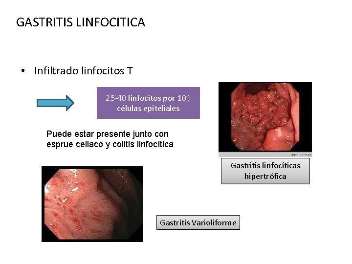 GASTRITIS LINFOCITICA • Infiltrado linfocitos T 25 -40 linfocitos por 100 células epiteliales Puede