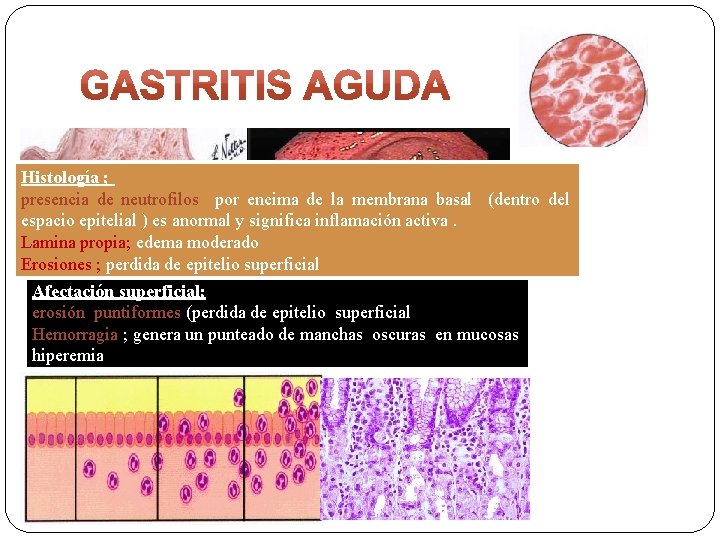 Histología ; presencia de neutrofilos por encima de la membrana basal (dentro del espacio