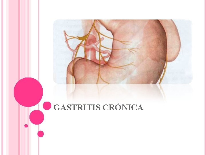 GASTRITIS CRÒNICA 