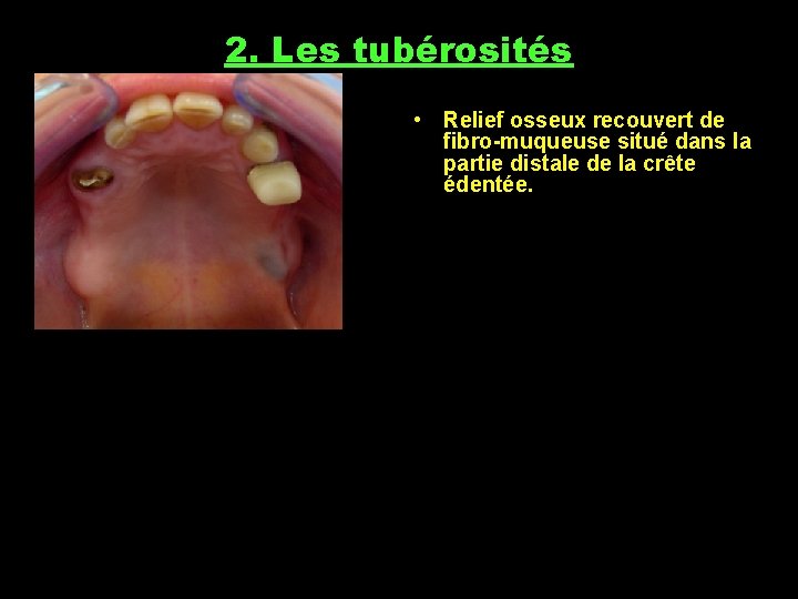 2. Les tubérosités • Relief osseux recouvert de fibro-muqueuse situé dans la partie distale