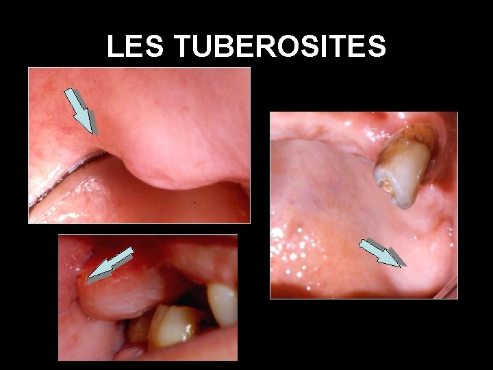 LES TUBEROSITES 