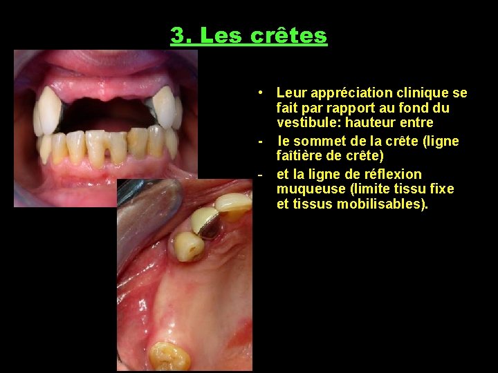 3. Les crêtes • Leur appréciation clinique se fait par rapport au fond du