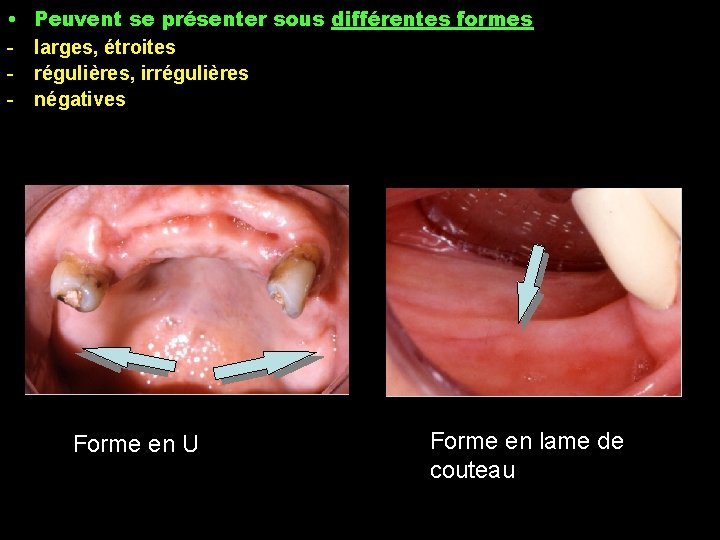  • - Peuvent se présenter sous différentes formes larges, étroites régulières, irrégulières négatives