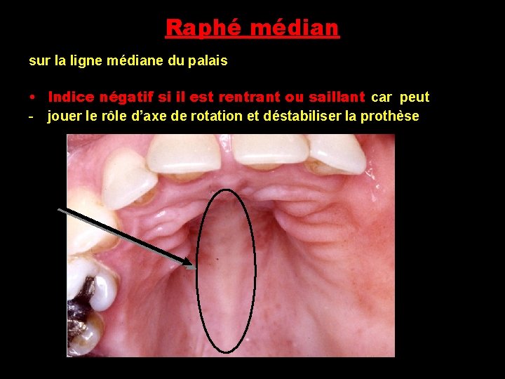 Raphé médian sur la ligne médiane du palais • Indice négatif si il est