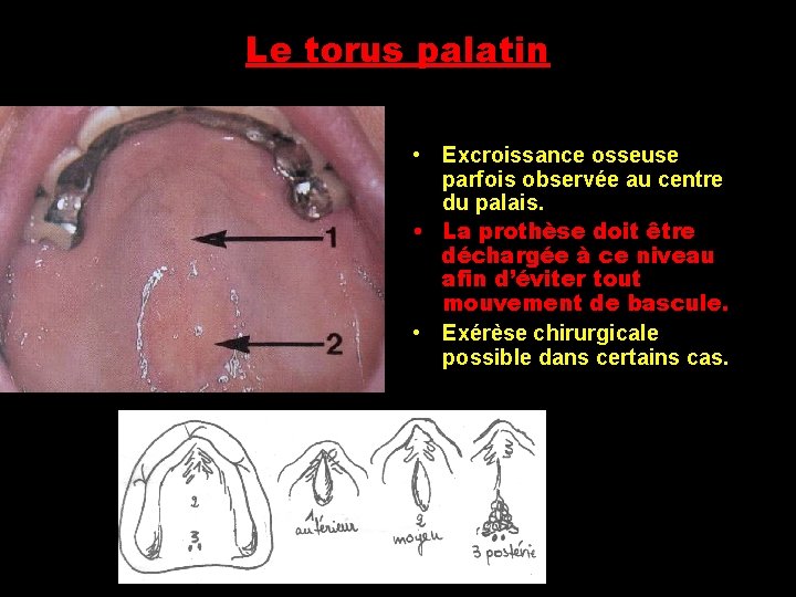 Le torus palatin • Excroissance osseuse parfois observée au centre du palais. • La