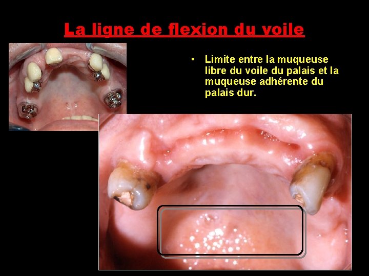 La ligne de flexion du voile • Limite entre la muqueuse libre du voile