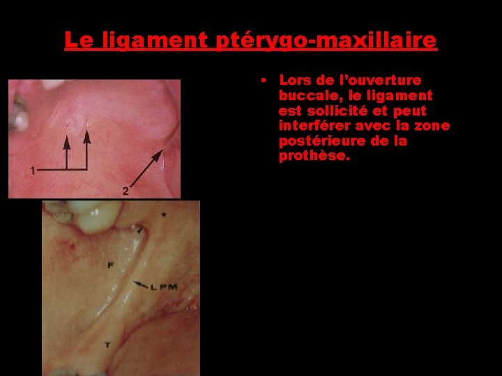 Le ligament ptérygo-maxillaire • Lors de l’ouverture buccale, le ligament est sollicité et peut