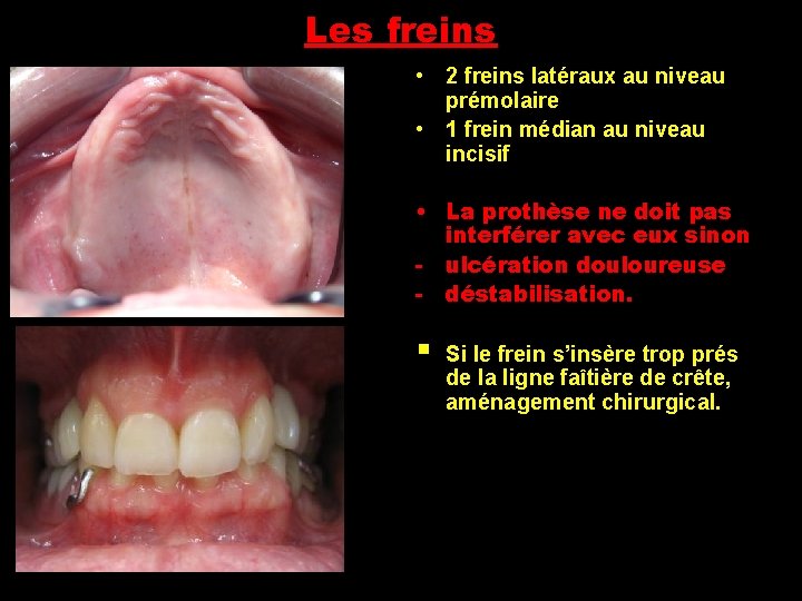 Les freins • 2 freins latéraux au niveau prémolaire • 1 frein médian au