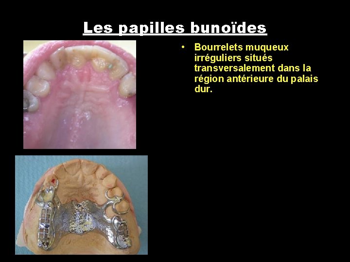 Les papilles bunoïdes • Bourrelets muqueux irréguliers situés transversalement dans la région antérieure du