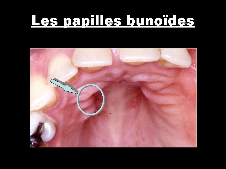 Les papilles bunoïdes 