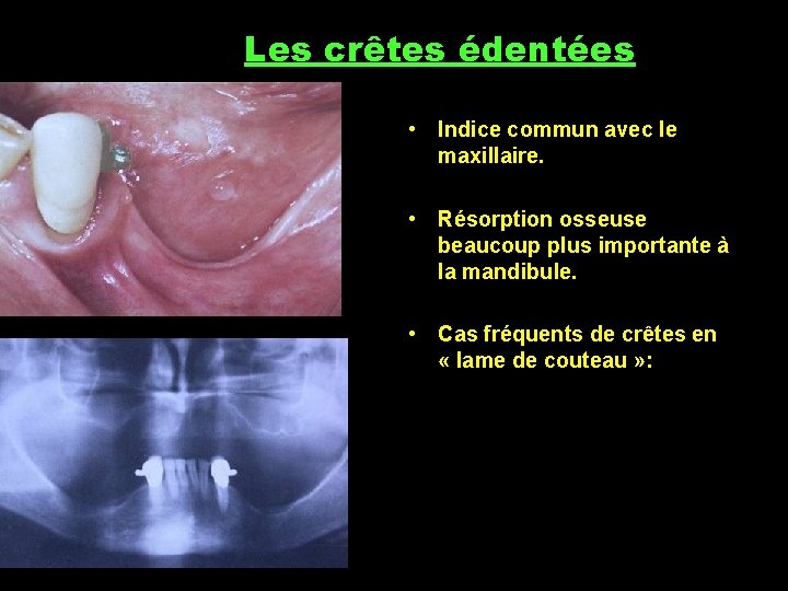 Les crêtes édentées • Indice commun avec le maxillaire. • Résorption osseuse beaucoup plus