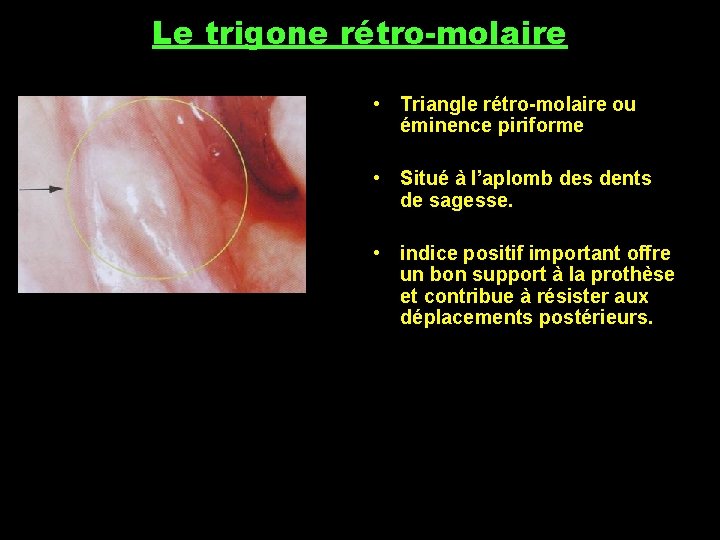 Le trigone rétro-molaire • Triangle rétro-molaire ou éminence piriforme • Situé à l’aplomb des