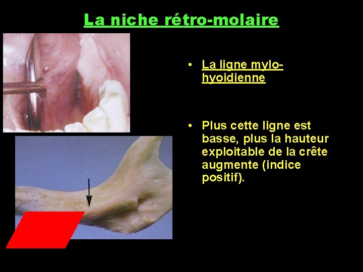 La niche rétro-molaire • La ligne mylohyoidienne • Plus cette ligne est basse, plus