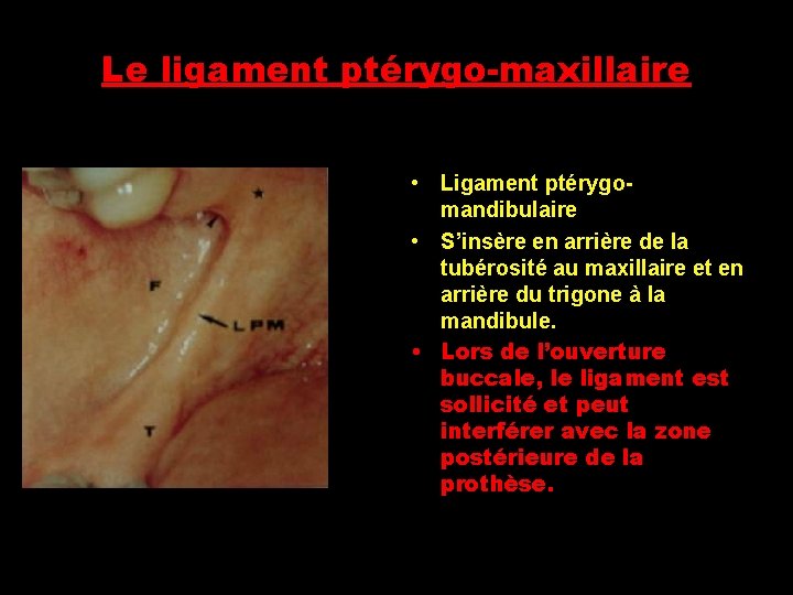 Le ligament ptérygo-maxillaire • Ligament ptérygomandibulaire • S’insère en arrière de la tubérosité au