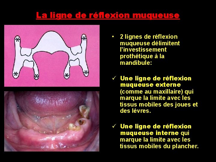 La ligne de réflexion muqueuse • 2 lignes de réflexion muqueuse délimitent l’investissement prothétique