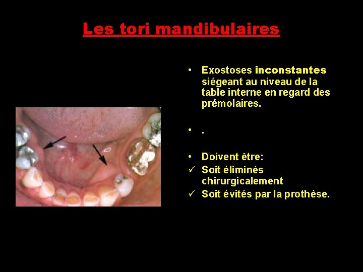 Les tori mandibulaires • Exostoses inconstantes siégeant au niveau de la table interne en