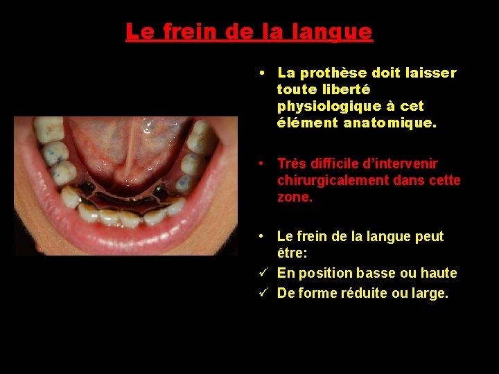 Le frein de la langue • La prothèse doit laisser toute liberté physiologique à