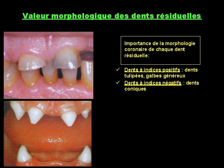 Valeur morphologique des dents résiduelles Importance de la morphologie coronaire de chaque dent résiduelle: