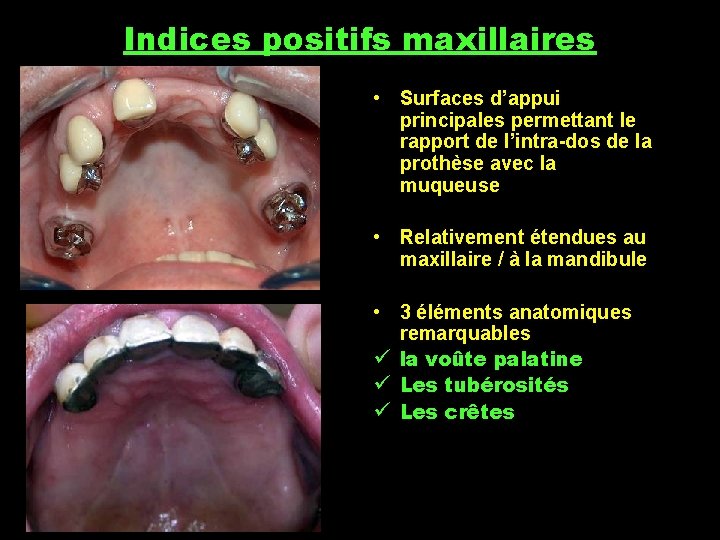 Indices positifs maxillaires • Surfaces d’appui principales permettant le rapport de l’intra-dos de la