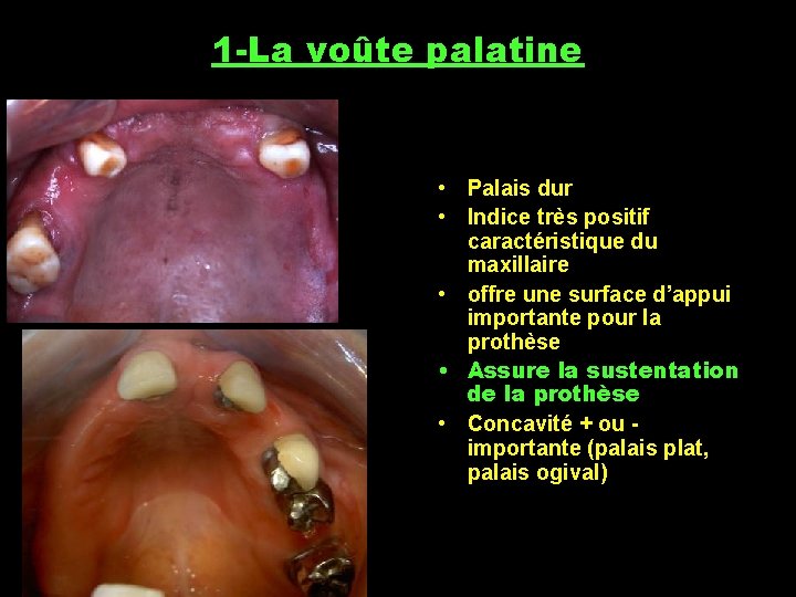 1 -La voûte palatine • Palais dur • Indice très positif caractéristique du maxillaire