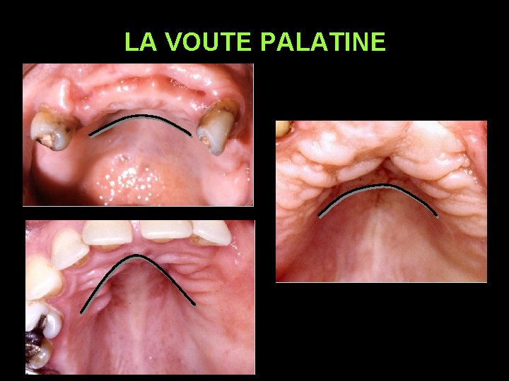 LA VOUTE PALATINE 