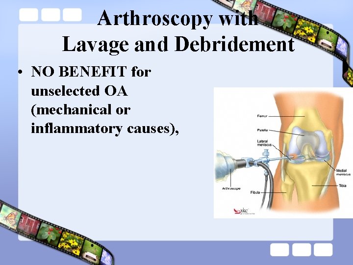 Arthroscopy with Lavage and Debridement • NO BENEFIT for unselected OA (mechanical or inflammatory