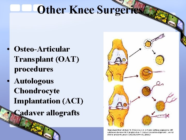 Other Knee Surgeries • Osteo-Articular Transplant (OAT) procedures • Autologous Chondrocyte Implantation (ACI) •