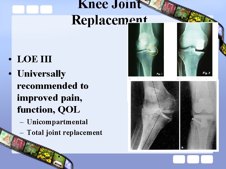 Knee Joint Replacement • LOE III • Universally recommended to improved pain, function, QOL