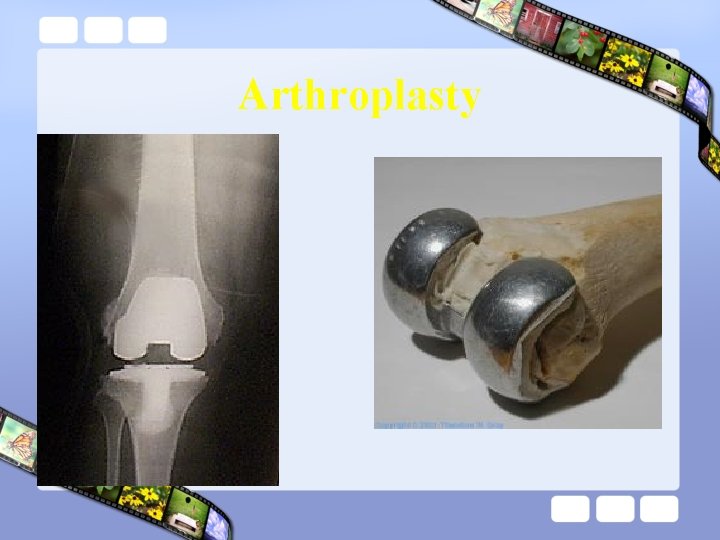 Arthroplasty 