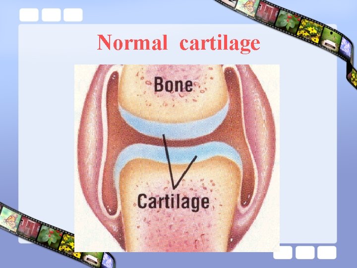 Normal cartilage 