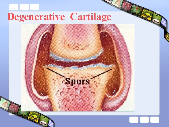 Degenerative Cartilage 