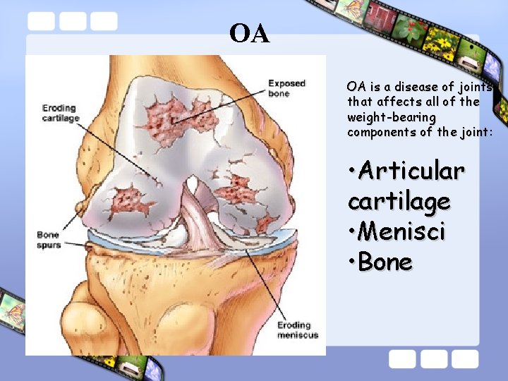 OA OA is a disease of joints that affects all of the weight-bearing components